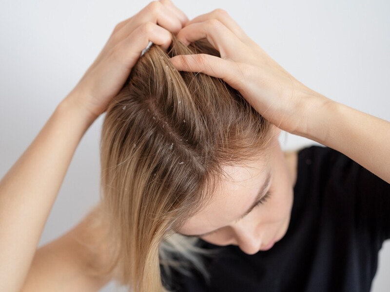 Minder zelfvertrouwen door haar- en hoofdhuidproblemen